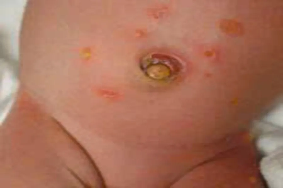 Trẻ bị viêm da mủ thường xuất hiện mụn mủ hoặc bọng nước trên da