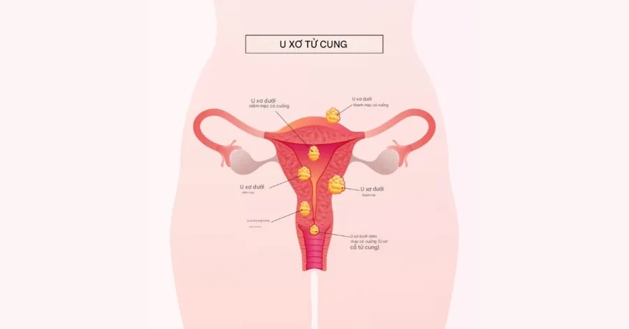 U xơ tử cung có thể ảnh hưởng đến khả năng mang thai hoặc gây biến chứng thai kỳ