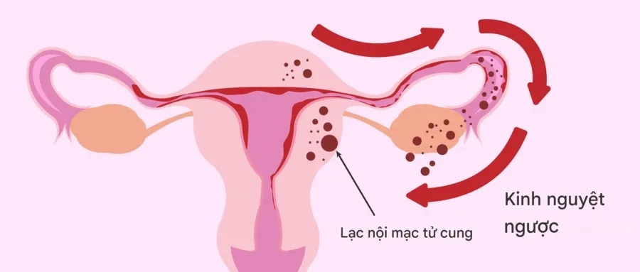 Kinh nguyệt trào ngược là giả thuyết được nhắc đến nhiều nhất trong cơ chế hình thành bệnh lạc nội mạc