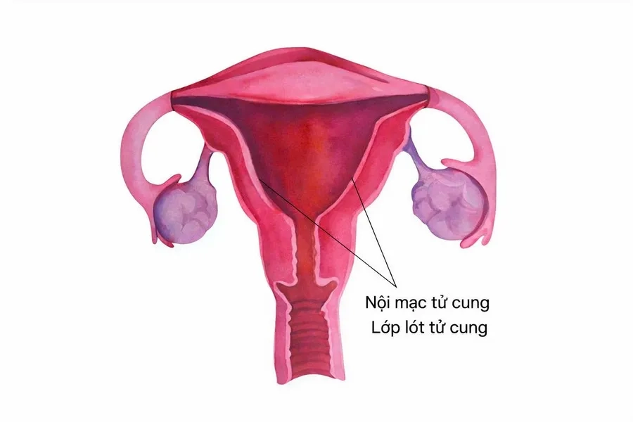 Nội mạc tử cung là lớp mô mềm lót mặt trong của tử cung