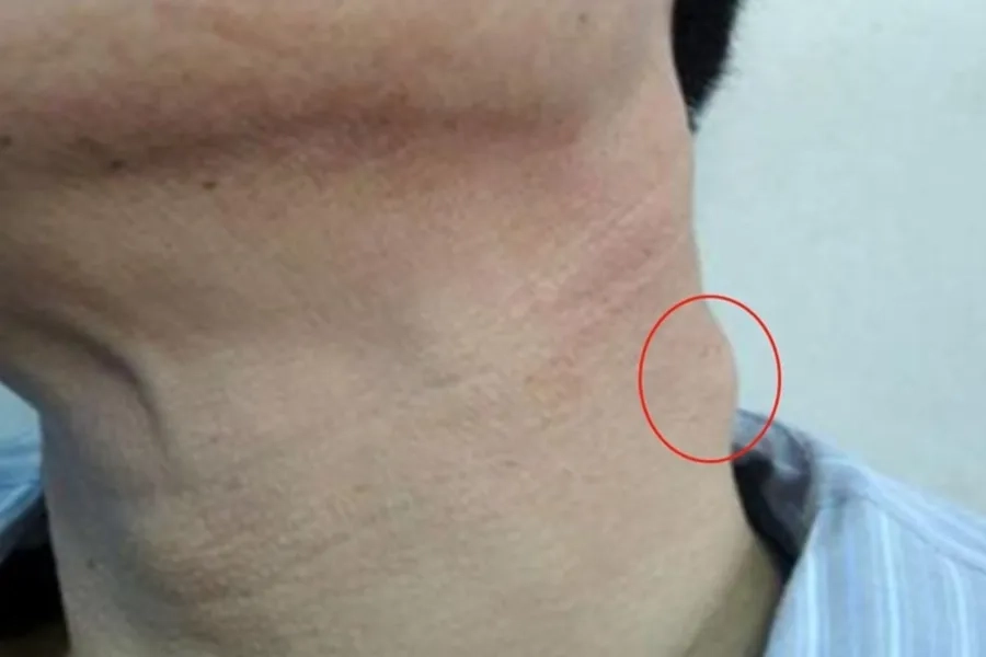 Nổi hạch vùng cổ có thể là biểu hiện cảnh báo khối u ác tính ở vòm họng
