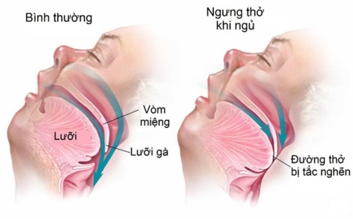 cau-truc-duong-tho-hoi-chung-khi-ngu