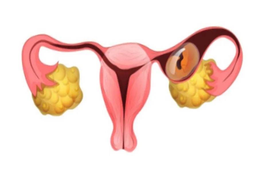 Bạn cần theo dõi chỉ số hCG để đánh giá thai ngoài tử cung