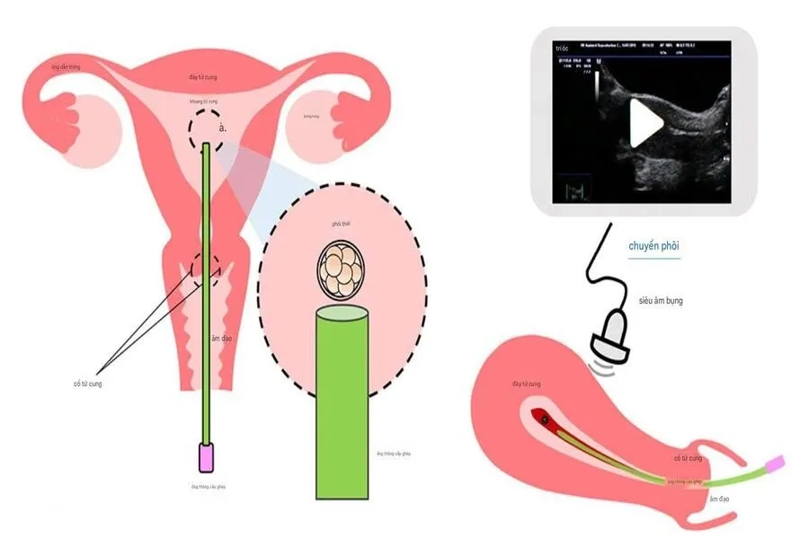 Chuyển phôi là bước quan trọng khi tiến hành IVF