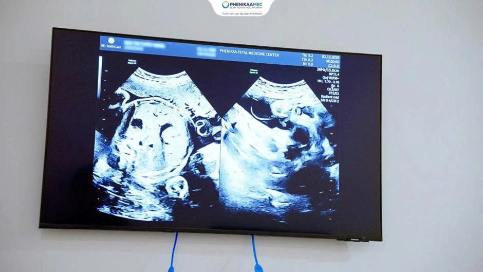 Sản phụ mang song thai rau tiền đạo sinh con an toàn tại PhenikaaMec sau 10 năm hiếm muộn