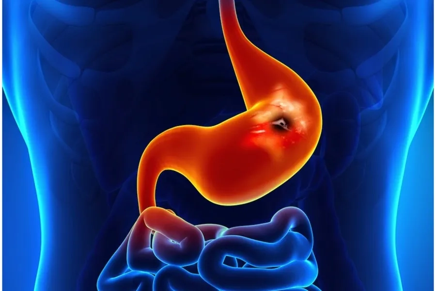 Bệnh có thể gây xuất huyết tiêu hóa nặng