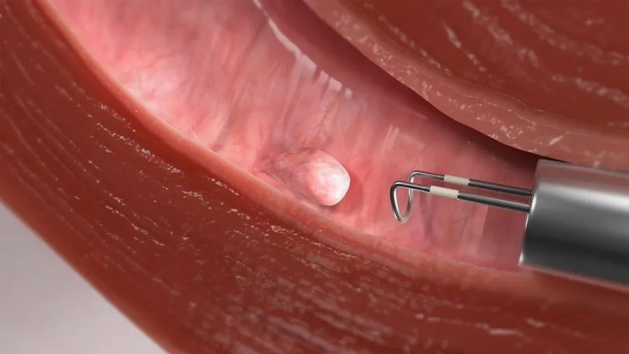 Phẫu thuật thường chỉ diễn ra trong khoảng 15 - 30 phút