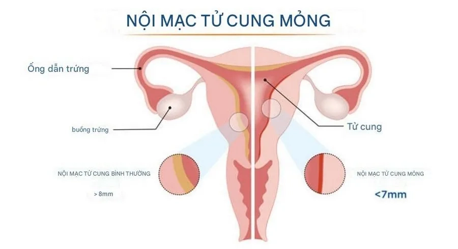 Niêm mạc tử cung được coi là mỏng khi độ dày dưới 7 mm trong giai đoạn sau rụng trứng