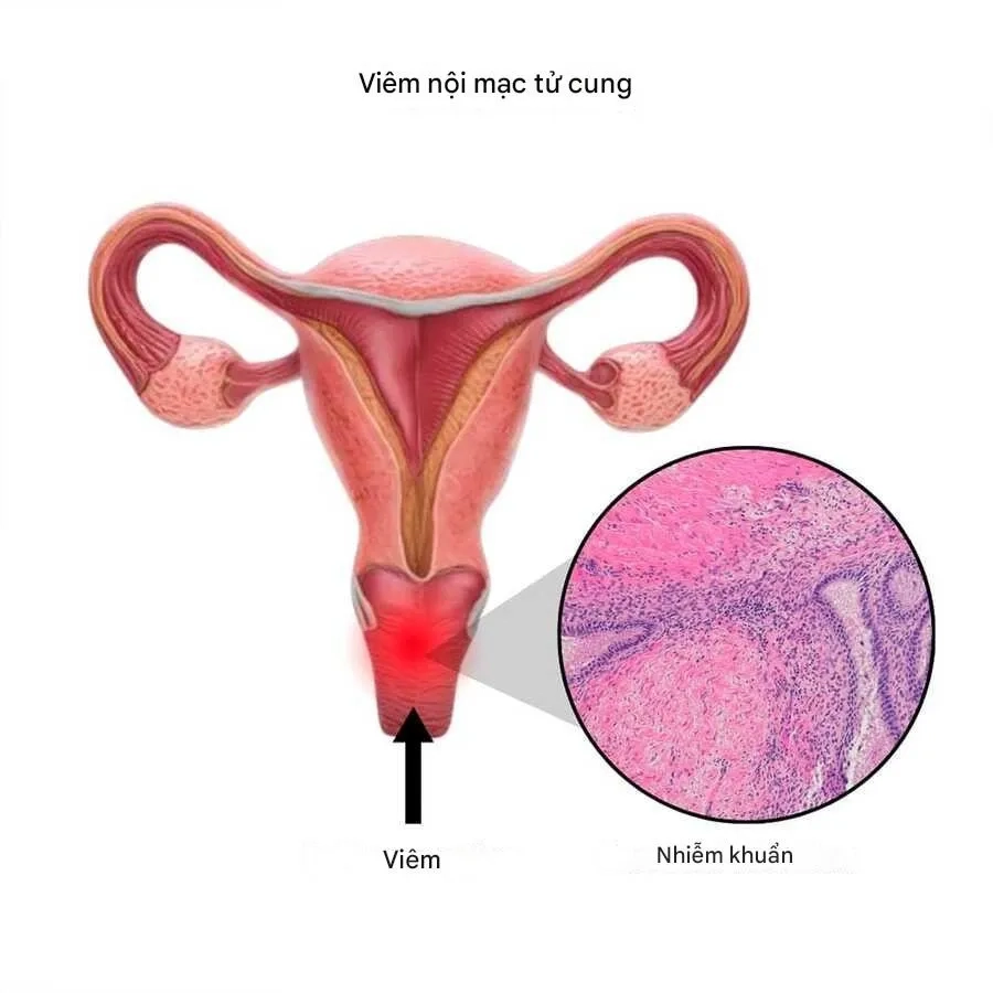 Viêm niêm mạc tử cung là tình trạng lớp niêm mạc lót bên trong buồng tử cung bị viêm nhiễm