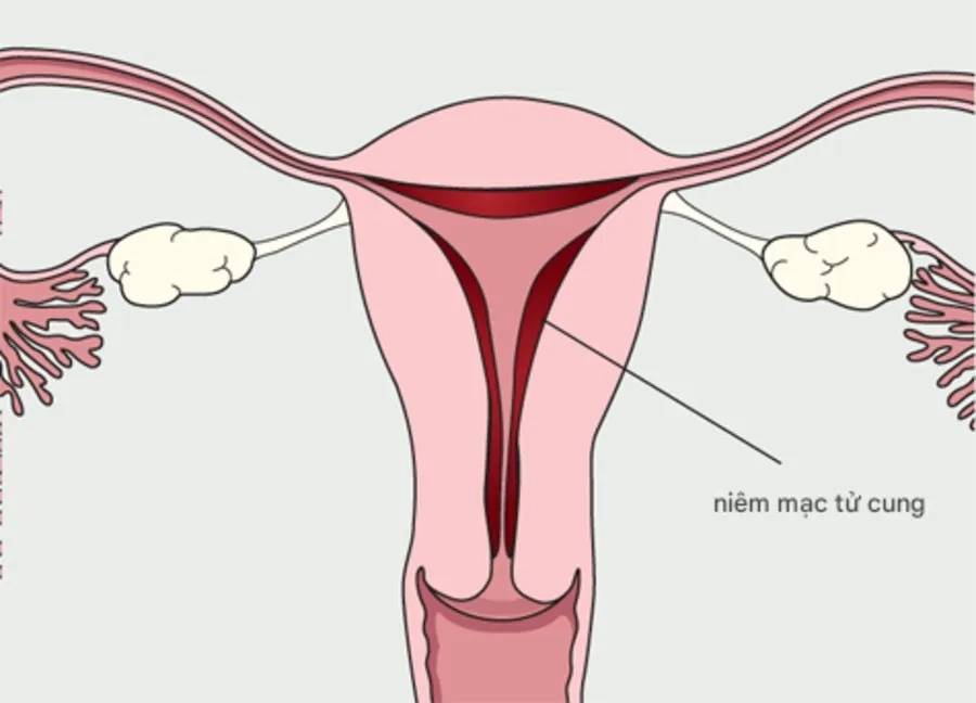 Nội mạc dày là tình trạng lớp niêm mạc lót bên trong buồng tử cung có độ dày vượt mức bình thường