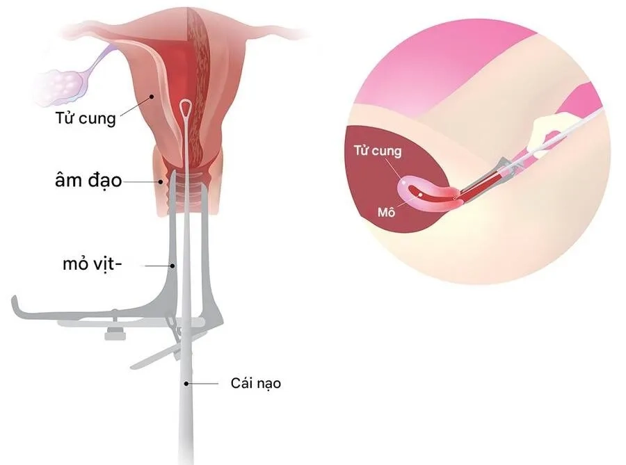 Đây là thủ thuật phụ khoa nhằm lấy một phần mô niêm mạc từ buồng tử cung