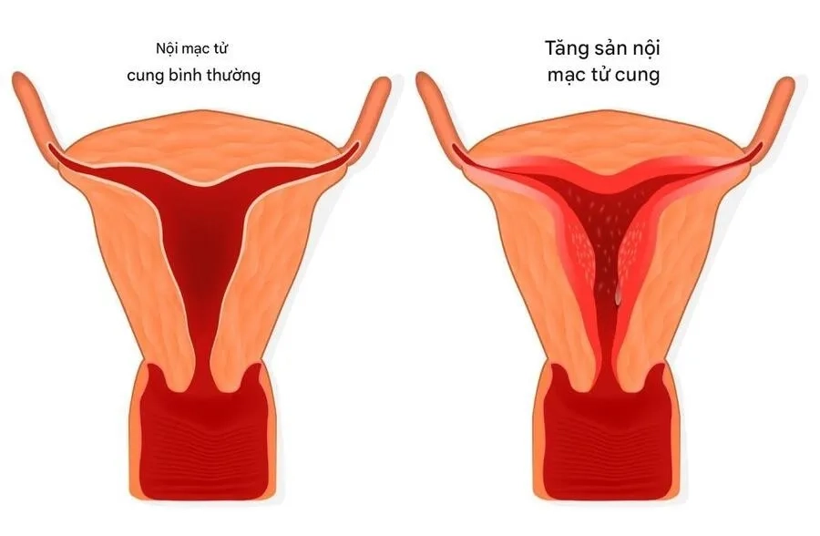 Quá sản niêm mạc tử cung (hay còn gọi là tăng sản nội mạc tử cung) là tình trạng lớp lót bên trong buồng tử cung tăng sinh quá mức và kéo dài