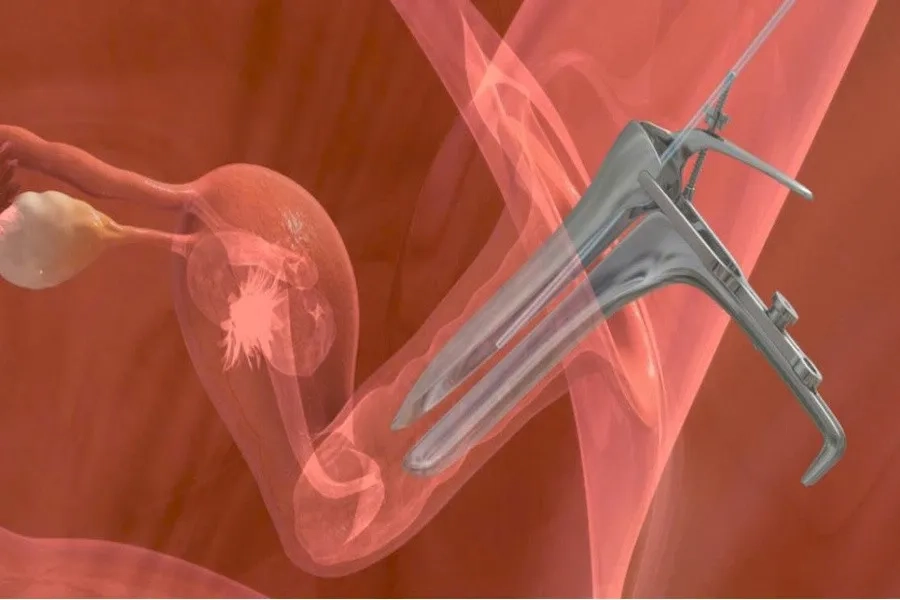 Chuyển phôi là bước quan trọng để đưa phôi đã thụ tinh vào làm tổ tại tử cung