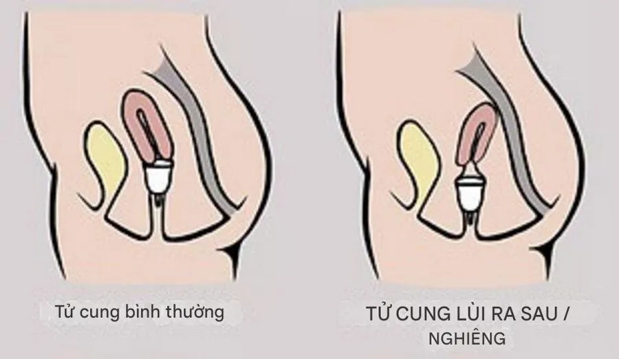 Tử cung nghiêng về phía sau được xem là một biến thể sinh lý bình thường của cấu trúc tử cung