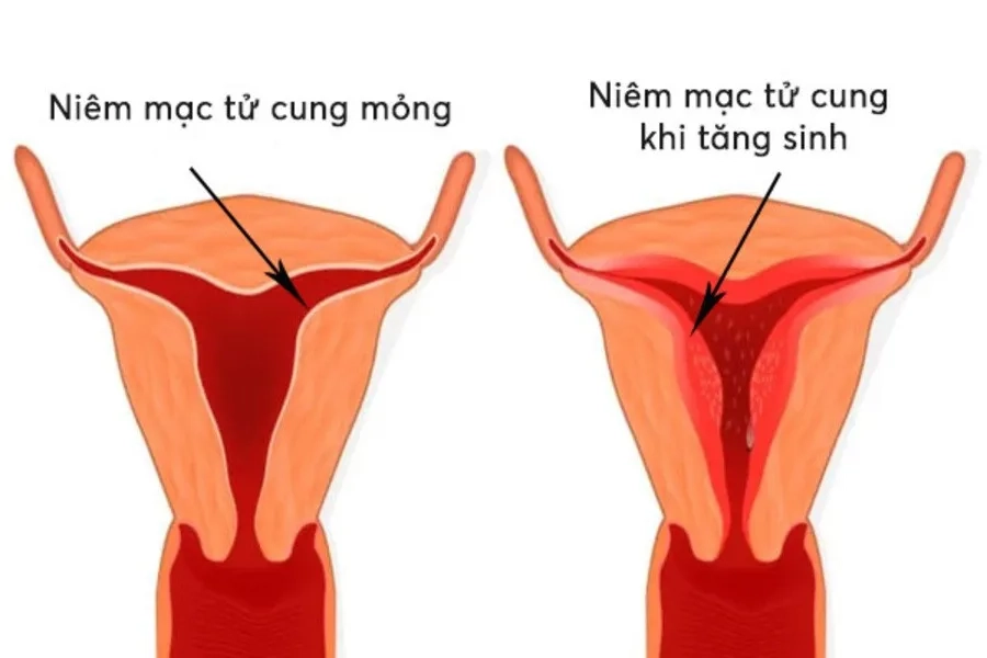 Niêm mạc tử cung quá dày hay quá mỏng đều có thể khiến phôi không bám vào