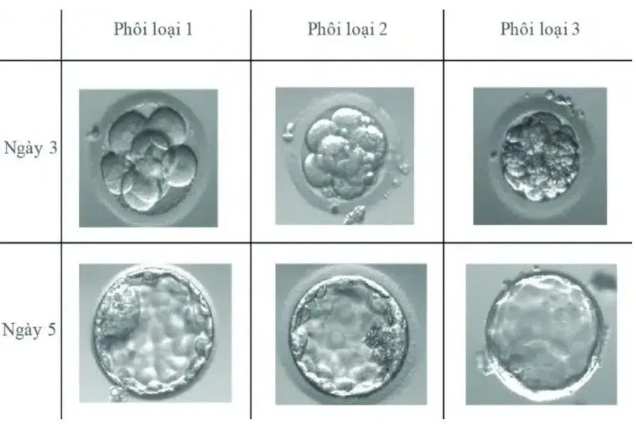 Chất lượng phôi quyết định tỷ lệ thành công của IVF