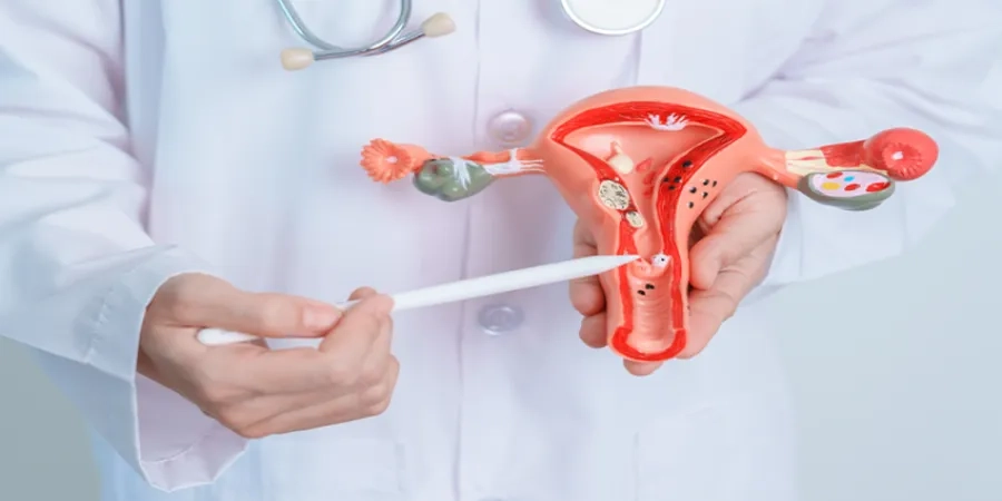 Nhân xơ tử cung là khối u lành tính, có kích thước trung bình từ 1 - 20mm