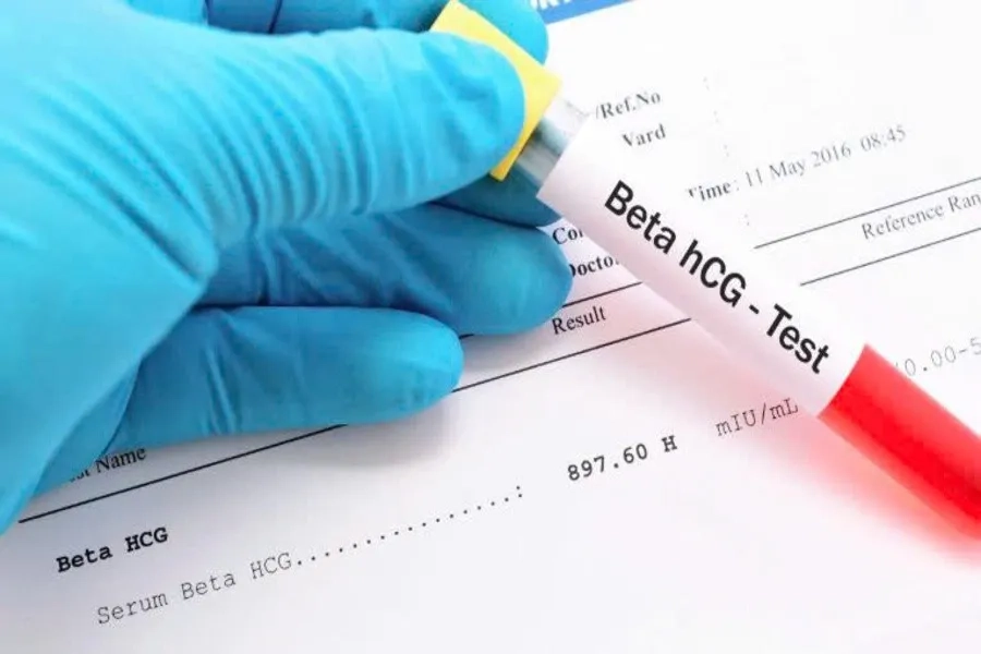 Nồng độ beta hCG lần đầu trên 25 mIU/ml cho thấy kết quả chuyển phôi thành công