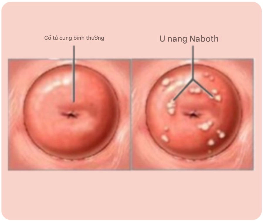 Nang Naboth là tổn thương lành tính, thường gặp ở phụ nữ trong độ tuổi sinh sản