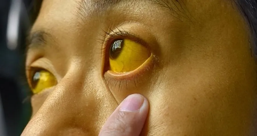 Tăng bilirubin máu và vàng da là một trong những hậu quả thường gặp của thiếu hụt G6PD