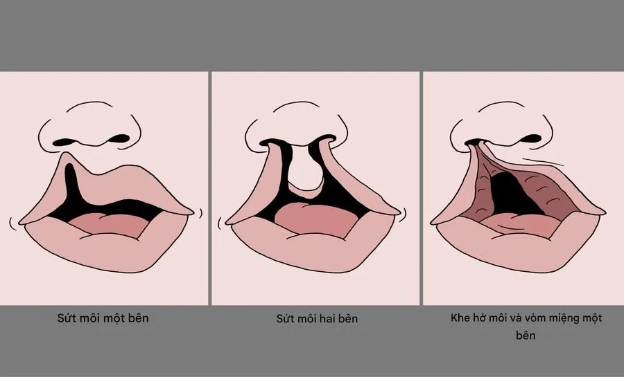 Trẻ bị sứt môi - hở hàm ếch do ảnh hưởng của hội chứng Patau
