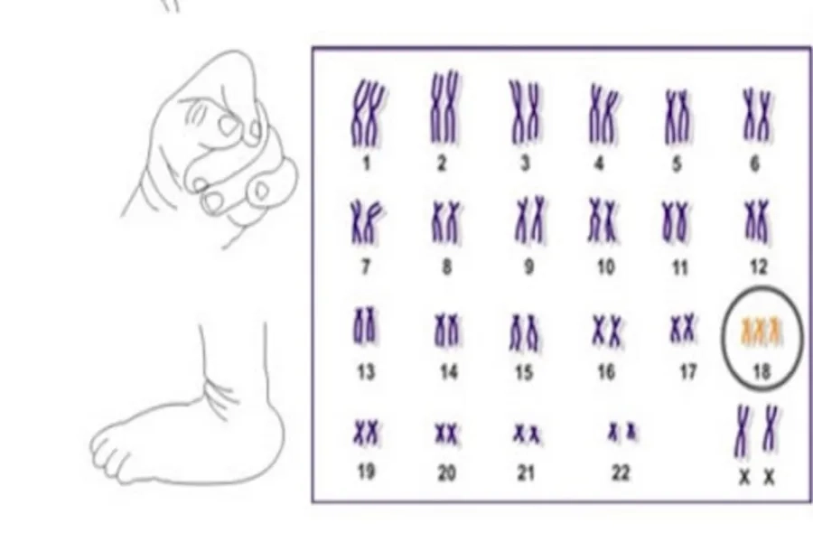 Xét nghiệm cho thấy thừa nhiễm sắc thể 18 chẩn đoán hội chứng Edwards (Trisomy 18)