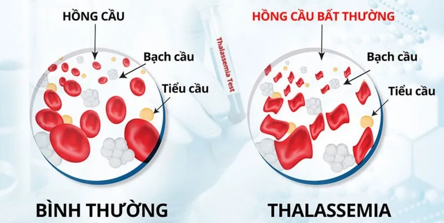 Tan máu bẩm sinh là một trong những căn bệnh di truyền lặn phổ biến tại Việt Nam