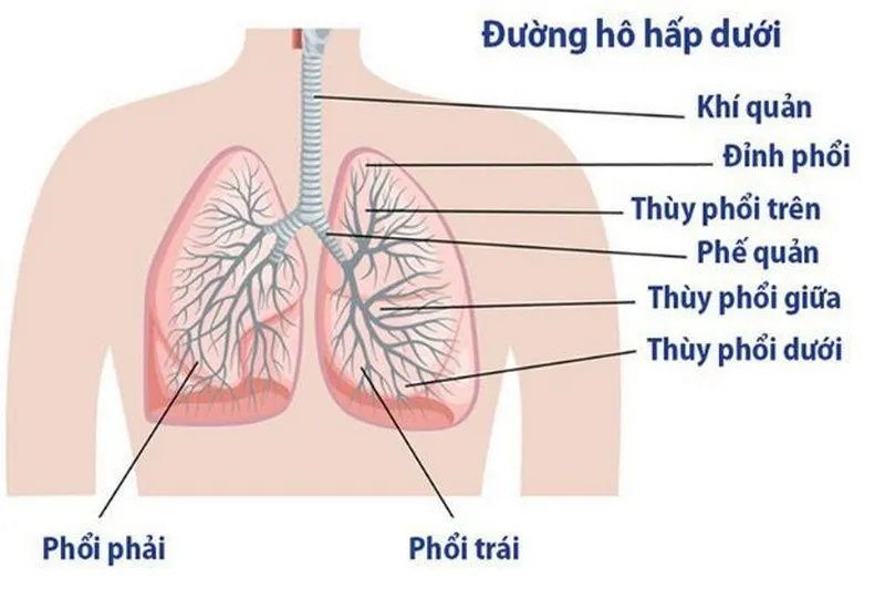 Viêm phổi thùy ở trẻ em là một bệnh lý do vi khuẩn tấn công