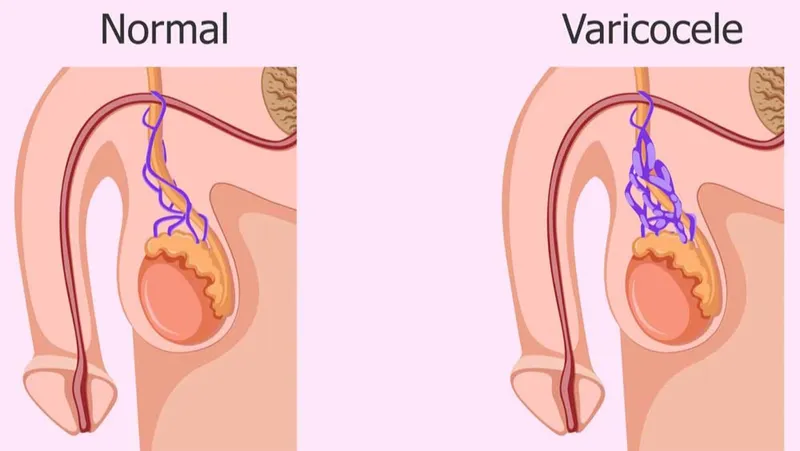 Giãn tĩnh mạch thừng tinh là một trong những nguyên nhân khiến tinh trùng loãng