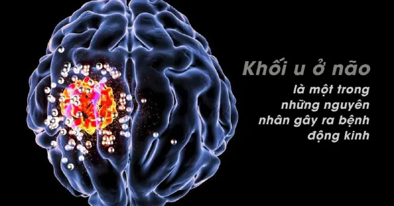 U não có thể là nguyên nhân gây bệnh giật kinh phong