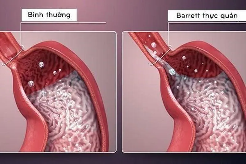 Barrett thực quản là một trong những biến chứng của bệnh trào ngược dạ dày