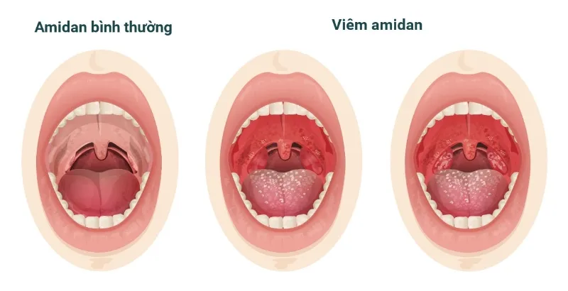 Viêm Amidan xơ teo là một biến chứng nghiêm trọng của chứng viêm amidan