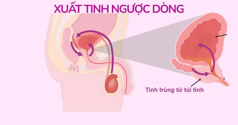 Xuất tinh ngược dòng có thể ảnh hưởng đến sức khỏe sinh sản của nam giới