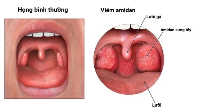 Viêm Amidan xơ teo có thể gây ra các bệnh hô hấp nghiêm trọng