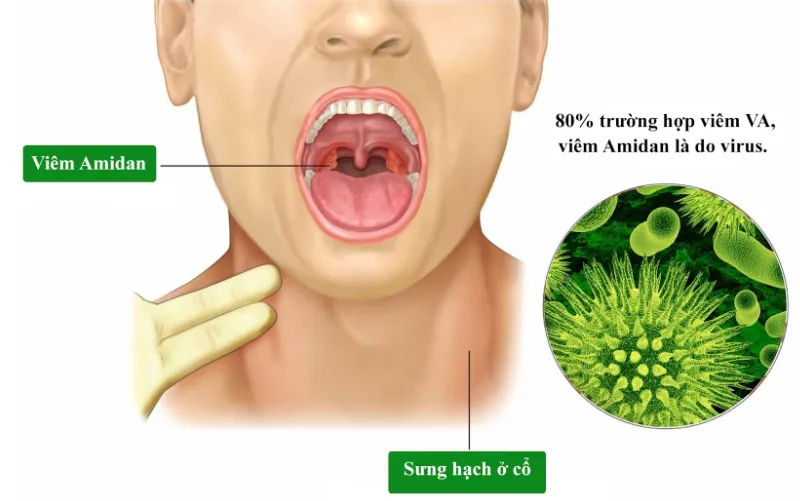 Viêm Amidan xơ teo bắt nguồn chính từ virus, vi khuẩn