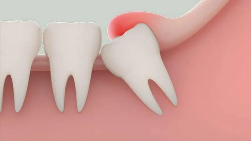 Răng khôn mọc gây nứt nướu, viêm nướu dễ gây đau nhức