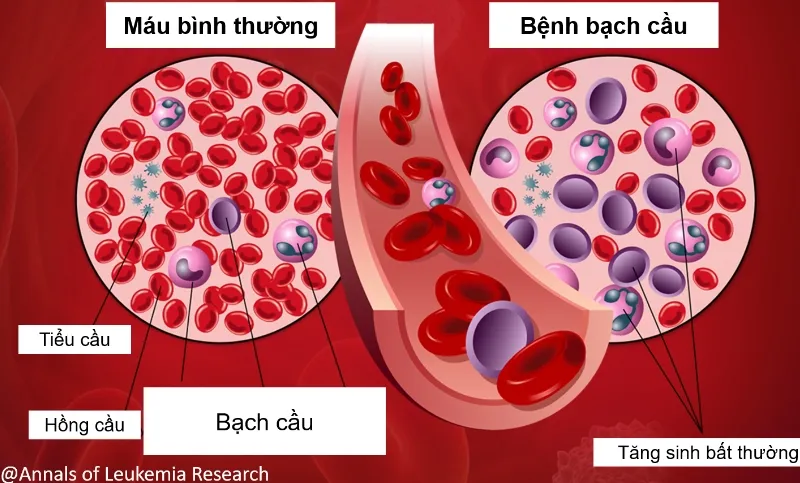 Ung thư bạch cầu là bệnh lý ung thư xuất phát từ tế bào bất thường trong tủy xương