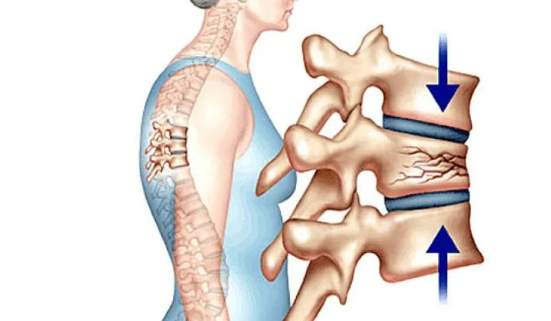 Đốt sống xẹp là tình trạng thân đốt sống có dấu hiệu xẹp xuống và biến dạng