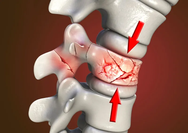 Nguyên nhân khiến đốt sống xẹp có thể do từng bị gãy xương