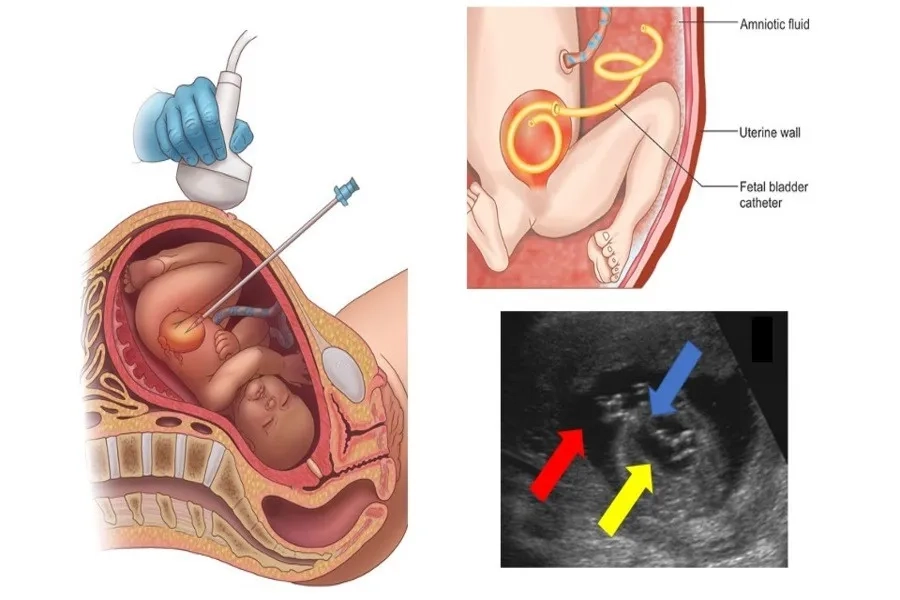 Kỹ thuật nội soi buồng ối dẫn lưu bàng quang thai nhi được thực hiện dưới hướng dẫn của siêu âm