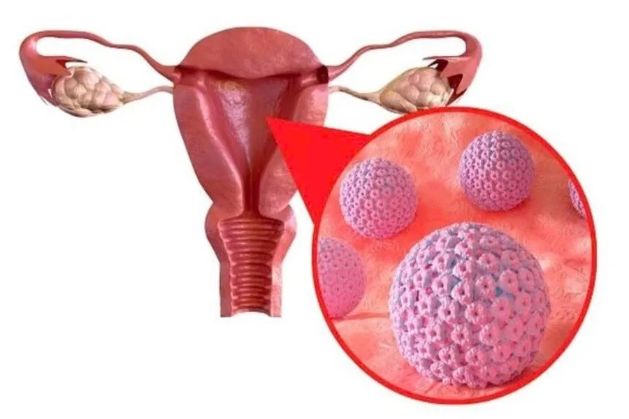 Virus HPV có thể tồn tại nhiều năm và tiến triển gây ung thư cổ tử cung