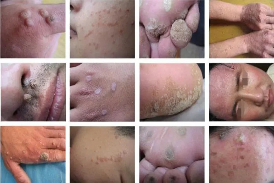 Virus HPV có thể gây mụn cóc sinh dục ở mặt, chân, tay