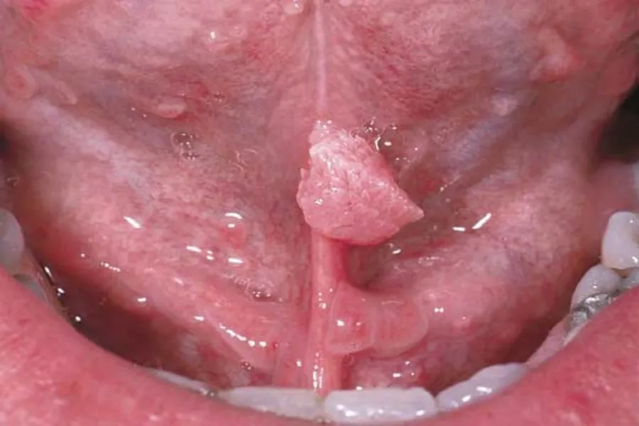 Virus HPV gây sùi mào gà ở miệng