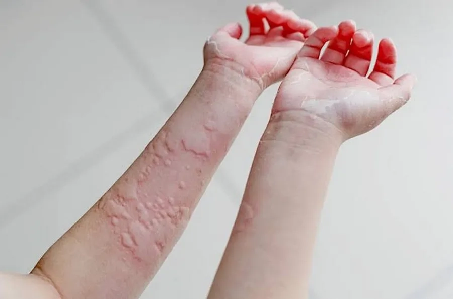 Khi phát hiện phản ứng mề đay sau tiêm cần phải báo ngay bác sĩ để được tư vấn