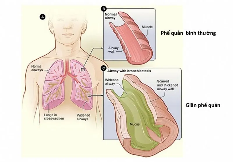 Giãn phế quản là tình trạng phế quản bị giãn một phần trong hệ thống đường thở