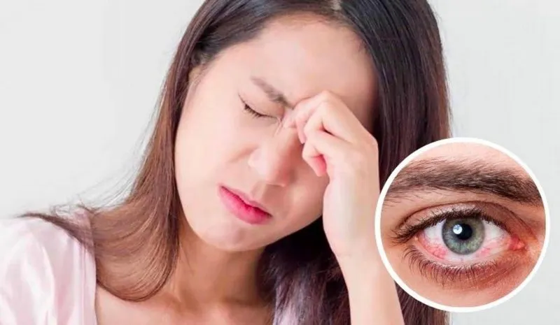 Bị viêm kết mạc thường thấy mắt đỏ, ngứa, cộm và nhiều dịch tiết