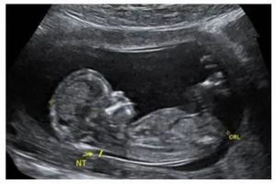 Siêu âm đo độ mờ da gáy khuyến nghị thực hiện từ trong khoảng tuần thai thứ 11 đến 13 tuần 6 ngày