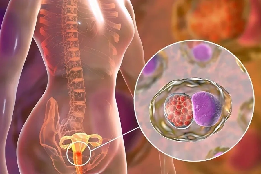 Virus HPV là nguyên nhân gây ung thư cổ tử cung ở phụ nữ