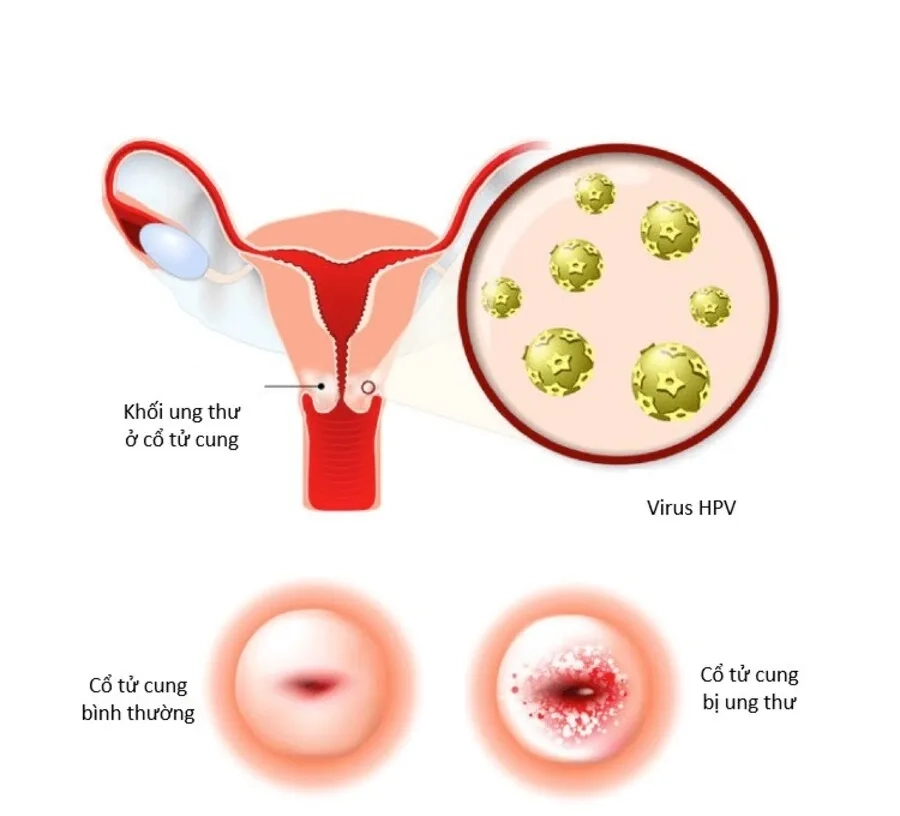Virus HPV – nguyên nhân chính gây ung thư cổ tử cung ở phụ nữ