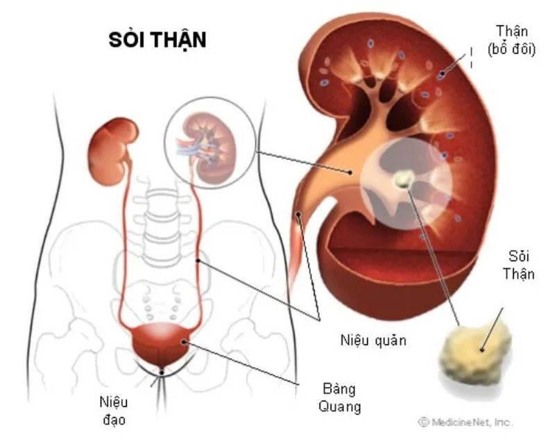 Sỏi thận là nguyên nhân chính chiếm 90% cơn đau quặn thận